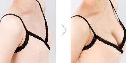 上海內窺鏡假體豐胸怎么樣？*內窺鏡假體豐胸介紹