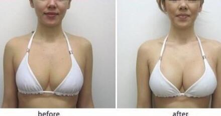 假體豐胸材料哪些好？假體豐胸*果圖
