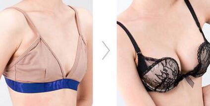 假體豐胸材料哪些好？假體豐胸*果圖