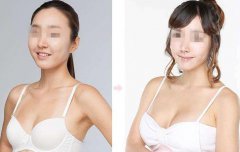 上海假體豐胸手術(shù)多少錢？上海假體豐胸價(jià)格？