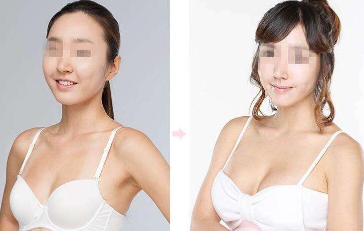 上海,假體豐胸手術(shù),多少錢(qián),價(jià)格