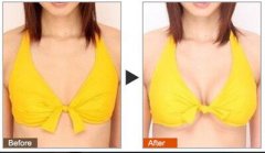 假體豐胸好的醫(yī)院有哪些？假體豐胸介紹？