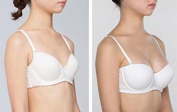 假體豐胸好的醫(yī)院有哪些？假體豐胸介紹？