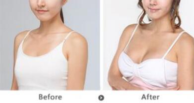 假體豐胸的副作用有哪些？假體豐胸*嗎？