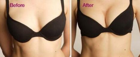 假體豐胸的副作用有哪些？假體豐胸*嗎？