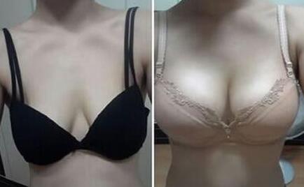 上海假體豐胸費用、上海假體豐胸手術(shù)多少錢？