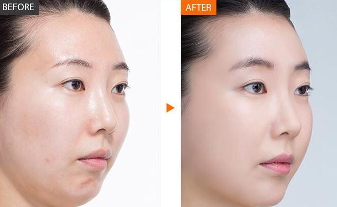 光子嫩膚*果能維持多久、全身光子嫩膚多少錢？