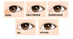 韓式開眼角手術(shù)果怎么樣？開眼角前后照