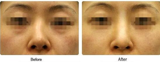 歪鼻矯正風(fēng)險(xiǎn)大嗎、歪鼻矯正手術(shù)多少錢