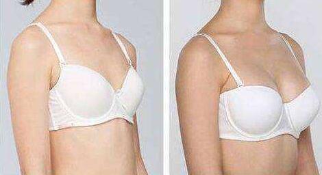 內(nèi)窺鏡隆胸到底痛不痛？?jī)?nèi)窺鏡隆胸多少錢？