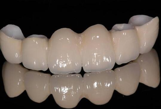 種植烤瓷牙,價(jià)格,多少錢