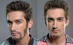 種植胡須充血怎么回事？種植胡須為什么會充血？