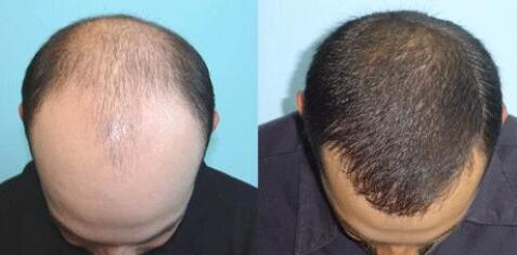 調(diào)節(jié)脫發(fā)多少費(fèi)用？上海調(diào)節(jié)脫發(fā)要多少錢？