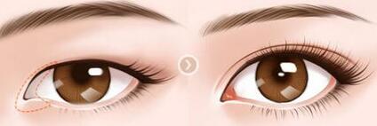 做開眼角大概多少錢？做開眼角的價(jià)格