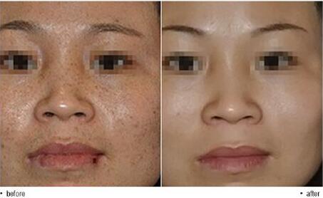 治雀斑,多少錢(qián),價(jià)格