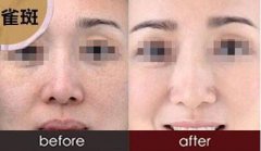 治雀斑的方法是什么？治雀斑的*方法？