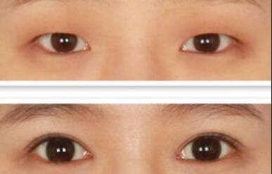 做開眼角價(jià)格、開眼角費(fèi)用詳細(xì)解析