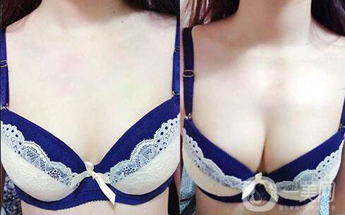 湛江做假體豐胸怎么樣？假體豐胸的*果好嗎？