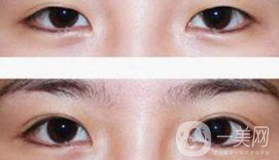 割雙眼皮多少錢(qián)？雙眼皮手術(shù)費(fèi)用詳細(xì)解答