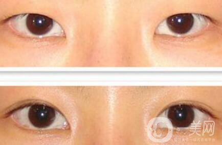 割雙眼皮多少錢(qián)？雙眼皮手術(shù)費(fèi)用詳細(xì)解答