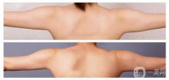 手臂吸脂術(shù)*嗎？手臂吸脂有危險(xiǎn)嗎？