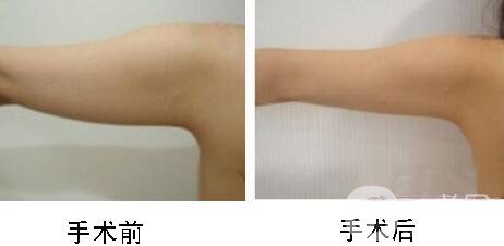 手臂吸脂術(shù)*嗎？手臂吸脂有危險嗎？