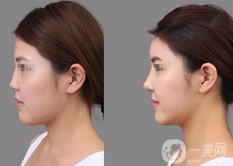 膨體隆鼻能維持多久？膨體隆鼻能保持終生嗎？