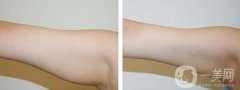 手臂吸脂術(shù)后怎么護(hù)理？術(shù)后注意事項(xiàng)有哪些？
