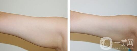 手臂吸脂術(shù)后怎么護(hù)理？術(shù)后注意事項有哪些？