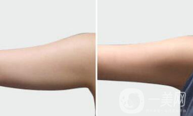 手臂吸脂術(shù)后怎么護(hù)理？術(shù)后注意事項有哪些？