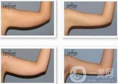 手臂吸脂風(fēng)險(xiǎn)有哪些？手臂吸脂有副作用嗎？