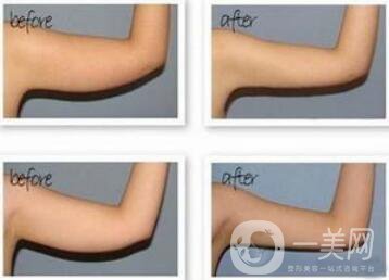 手臂吸脂風險有哪些？手臂吸脂有副作用嗎？