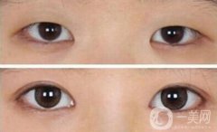 開(kāi)眼角需要多少錢(qián)？開(kāi)眼角和不開(kāi)的區(qū)別圖