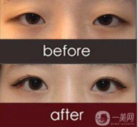 改臉型手術多少錢？改臉型手術有危險嗎？