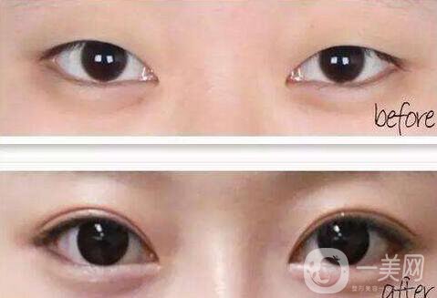 雙眼皮開眼角價(jià)格是多少？割雙眼皮開眼角多少錢？