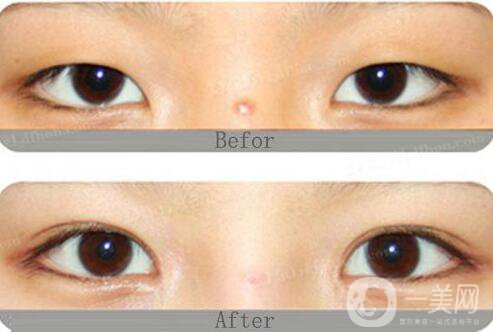 開(kāi)眼角割雙眼皮價(jià)格、開(kāi)眼角割雙眼皮多少錢？