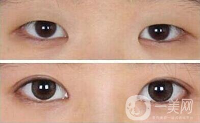 開(kāi)眼角割雙眼皮價(jià)格、開(kāi)眼角割雙眼皮多少錢？