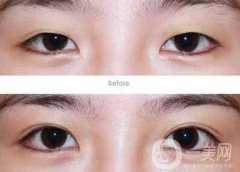 成都割雙眼皮哪里專業(yè)？割雙眼皮介紹？