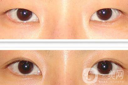 成都割雙眼皮哪里專業(yè)？割雙眼皮介紹？