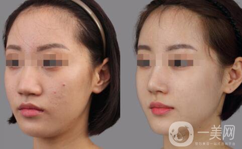 深圳做硅膠隆鼻多少錢(qián)？硅膠隆鼻費(fèi)用詳細(xì)解析