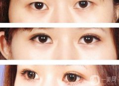 割雙眼皮要花多少錢(qián)？割雙眼皮手術(shù)價(jià)格詳細(xì)解析