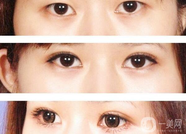 割雙眼皮要花多少錢？割雙眼皮手術(shù)價格詳細解析