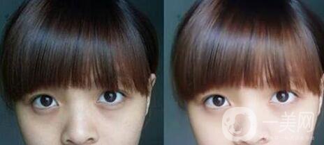 黑眼圈可以打玻尿酸嗎？玻尿酸去黑眼圈*果如何？