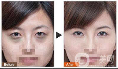 黑眼圈可以打玻尿酸嗎？玻尿酸去黑眼圈*果如何？