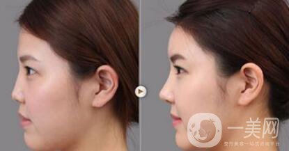 上海假體隆鼻多少費(fèi)用？假體隆鼻價(jià)格詳細(xì)分析