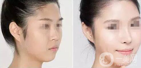 上海假體隆鼻多少費(fèi)用？假體隆鼻價(jià)格詳細(xì)分析