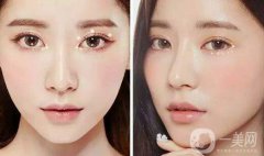  切割雙眼皮恢復多久好