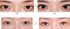 杭州割雙眼皮價格貴不貴？價格是多少？