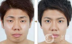 男士割雙眼皮果怎樣？有哪些方式？