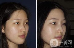 廣東硅膠隆鼻需要多少錢呢？廣東硅膠隆鼻價格？